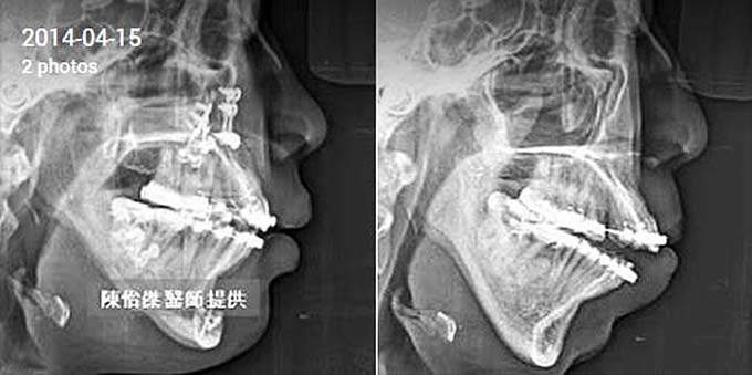 陳怡傑醫師|正顎手術治療第二型咬合不良 (暴牙、下巴後縮) 案例