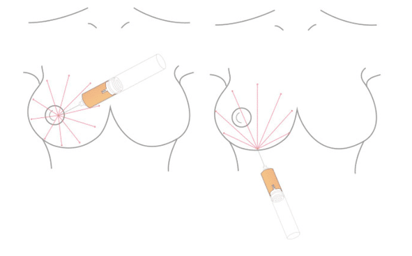 陳廣得醫師｜做手術前先了解：什麼是自體脂肪隆乳？