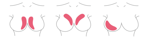 陳廣得醫師｜做手術前先了解：什麼是自體脂肪隆乳？