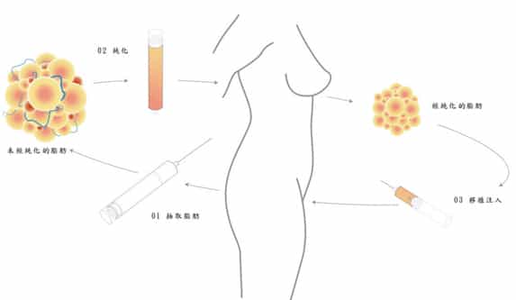 陳廣得醫師｜做手術前先了解：什麼是自體脂肪隆乳？