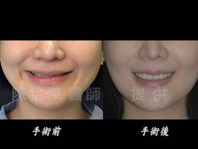 陳怡傑醫師｜ 做正顎手術一定要配合牙齒矯正嗎？