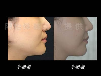 陳怡傑醫師｜ 做正顎手術一定要配合牙齒矯正嗎？