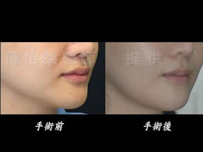陳怡傑醫師｜ 做正顎手術一定要配合牙齒矯正嗎？