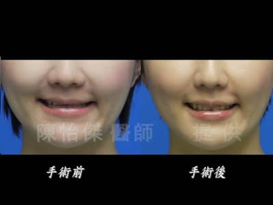 陳怡傑醫師｜ 做正顎手術一定要配合牙齒矯正嗎？