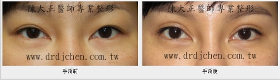 陳大正醫師｜5種常見的雙眼皮重修手術情形