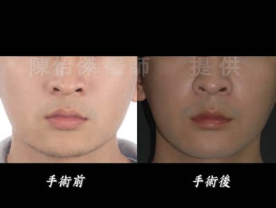 陳怡傑醫師｜ 做正顎手術一定要配合牙齒矯正嗎？