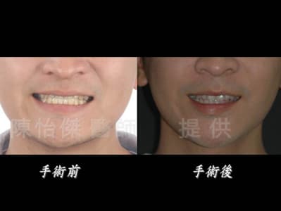 陳怡傑醫師｜ 做正顎手術一定要配合牙齒矯正嗎？