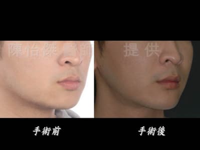 陳怡傑醫師｜ 做正顎手術一定要配合牙齒矯正嗎？