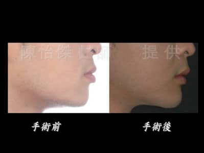 陳怡傑醫師｜ 做正顎手術一定要配合牙齒矯正嗎？
