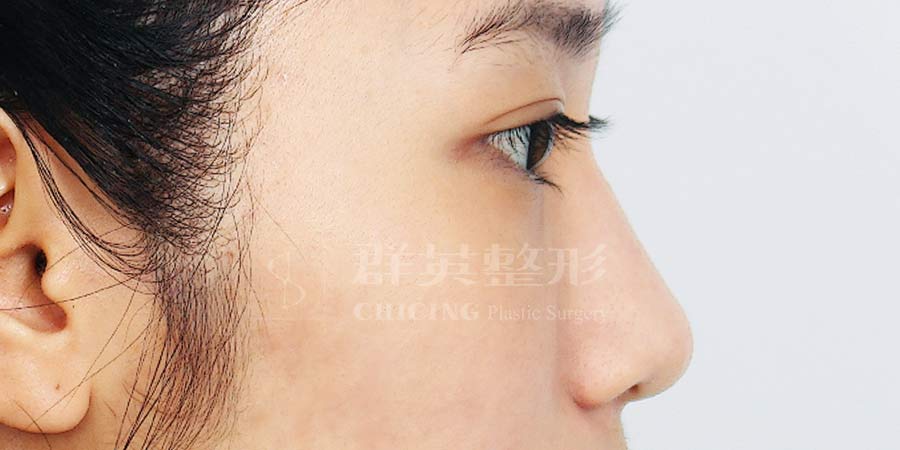 隆鼻案例 CH16023A 術前後