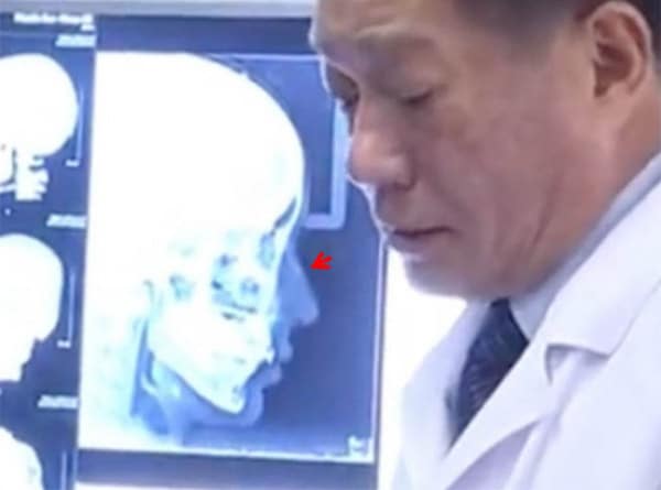 陳怡傑醫師｜從Angelababy鼻子裡的那一根異物談起(下)