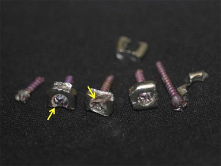陳怡傑醫師｜特殊設計的顏面骨釘