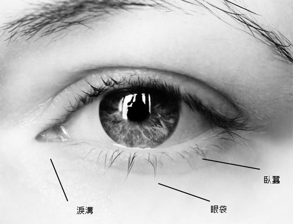 蕭弘道醫師｜衰老醜態與迷人桃花──眼袋、臥蠶與淚溝