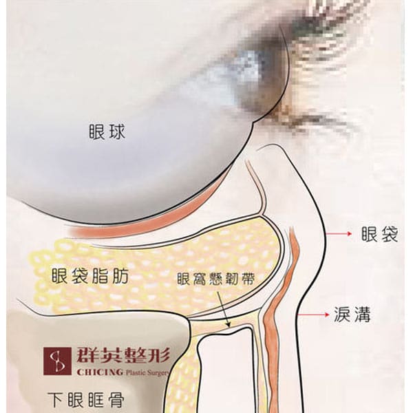 陳歷舜醫師|眼袋復發?開完眼袋會再長出來?