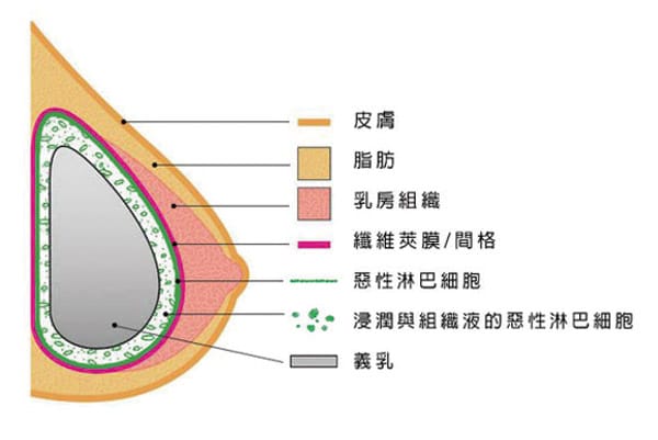 隆乳可能致癌？醫師：發生機率低！術後定期追蹤，安心打造自然渾圓胸
