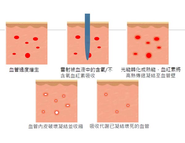 侯憲棋醫師於整形外科醫學會分享血管雷射治療