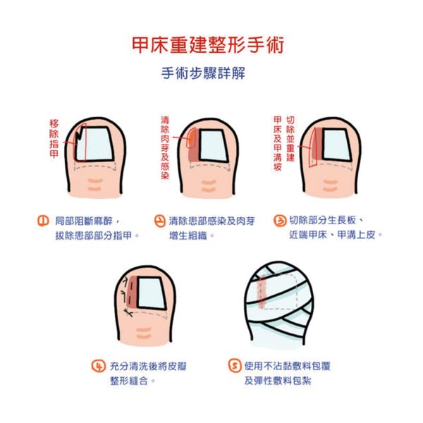 【甲溝炎治療系列】甲溝炎(凍甲)治療概論｜侯憲棋醫師