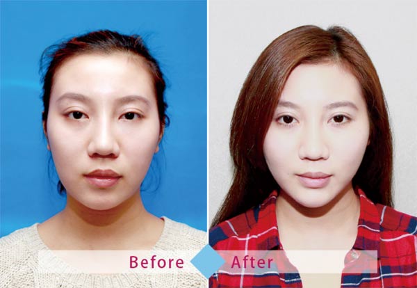 輕熟女的秘密保養「微創拉提」撫平初熟齡細紋、肌膚鬆垮問題！