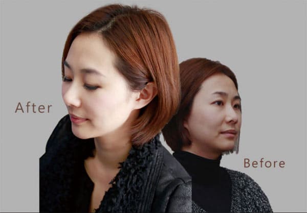 輕熟女的秘密保養「微創拉提」撫平初熟齡細紋、肌膚鬆垮問題！