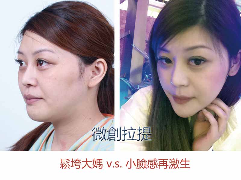 輕熟女的秘密保養「微創拉提」撫平初熟齡細紋、肌膚鬆垮問題！