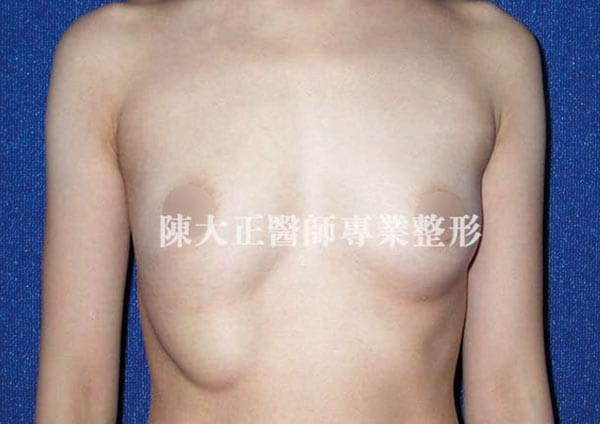 免開刀比較安全？中國女捧雙層乳跨海求醫，「奧美定隆乳」藏風險！｜風傳媒