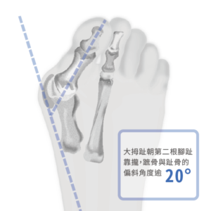 拇趾外翻