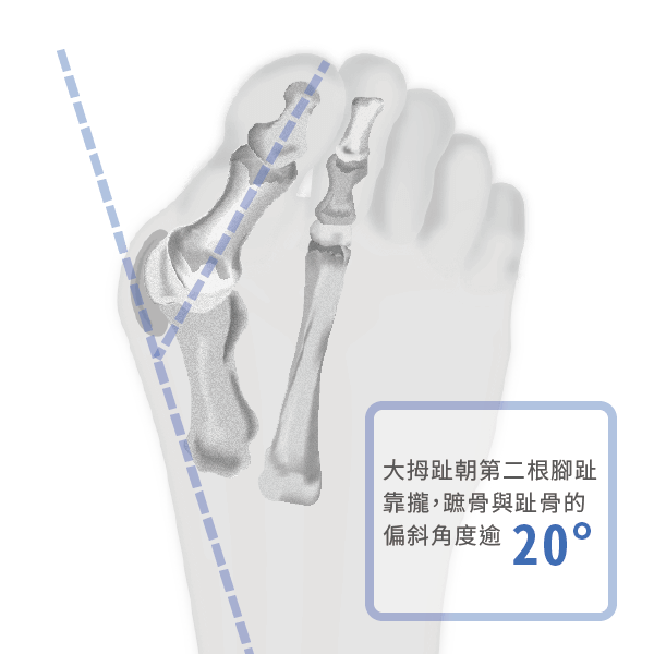 拇趾外翻