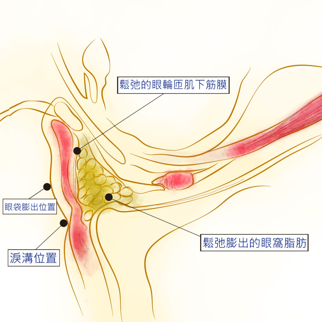 張世幸醫師｜內視鏡運用　前額拉皮還能算是「大」手術嗎？