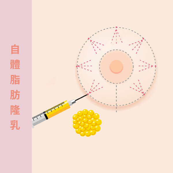加深事業線　先搞懂隆乳植入物