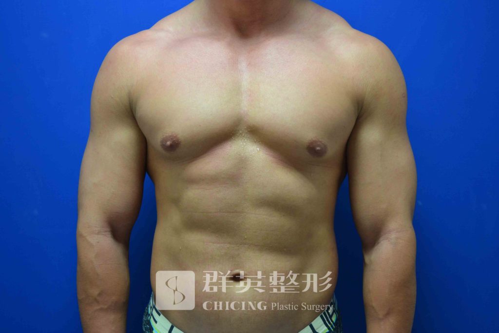 【男性女乳症】「性感」的困擾（上）｜陳大正醫師、蘇毓彬醫師