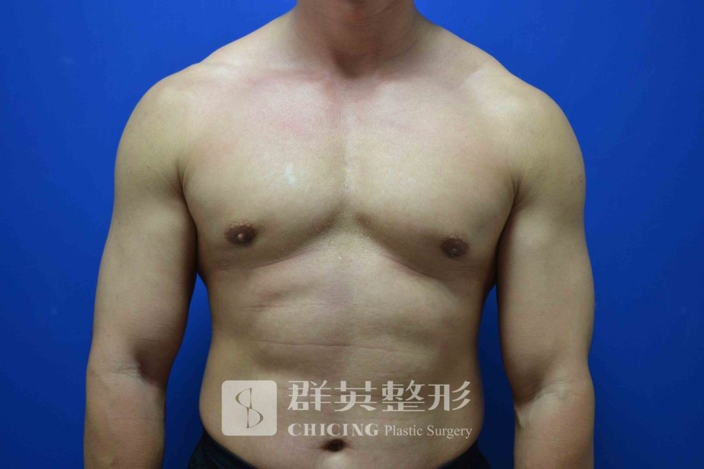 【男性女乳症】「性感」的困擾（下）｜陳大正醫師、蘇毓彬醫師