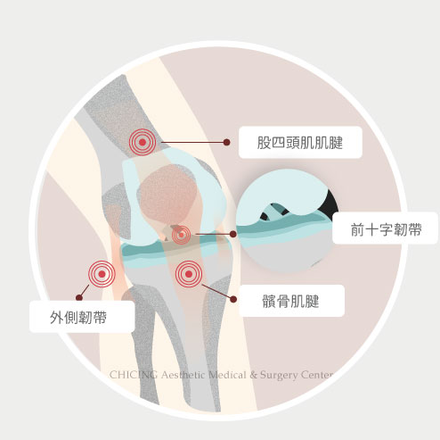 不動刀｜膝蓋退化、肩關節退化、運動傷害