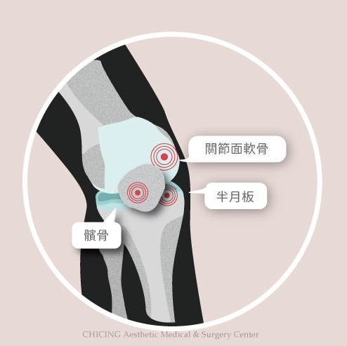 不動刀｜膝蓋退化、肩關節退化、運動傷害
