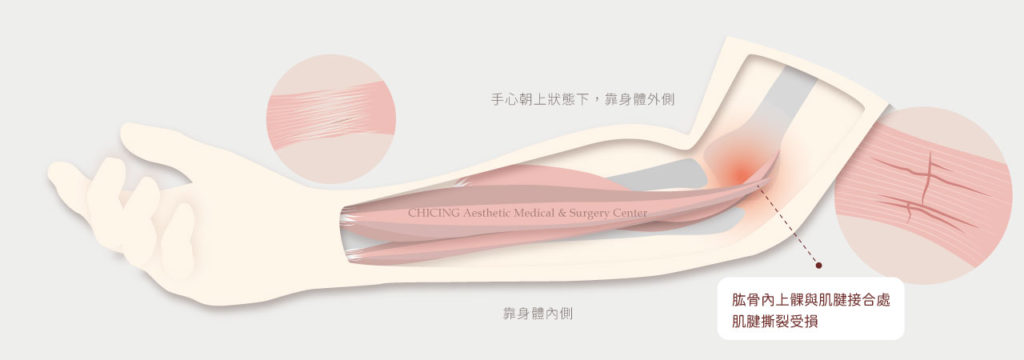 不動刀｜膝蓋退化、肩關節退化、運動傷害