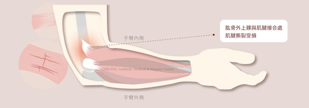 不動刀｜膝蓋退化、肩關節退化、運動傷害
