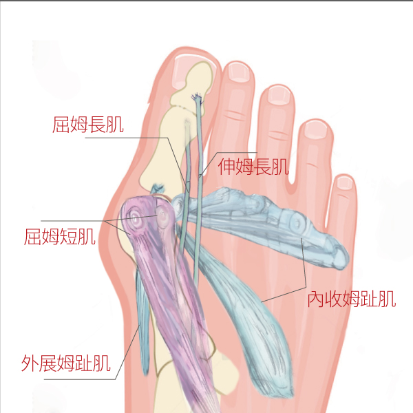 【美腿攻略】我還年輕　拇趾外翻不用心驚驚?!｜陳建璋醫師