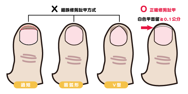 【甲溝炎治療系列】「錯剪趾甲」惹禍?!談再發性甲溝炎治療｜侯憲棋醫師