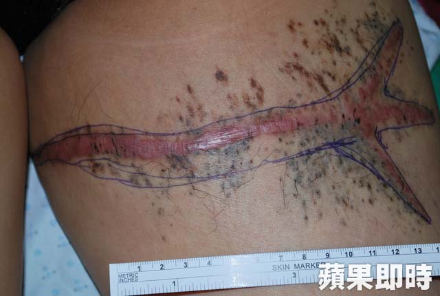 小黑痣竟擴散成手掌大獸皮 人妻1年開9次刀才清除｜ 蘋果即時