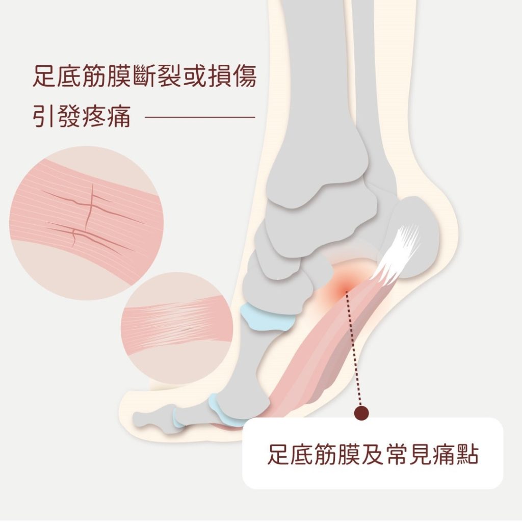 長年慢跑腳刺痛！跑步也會導致足底筋膜炎？｜風傳媒