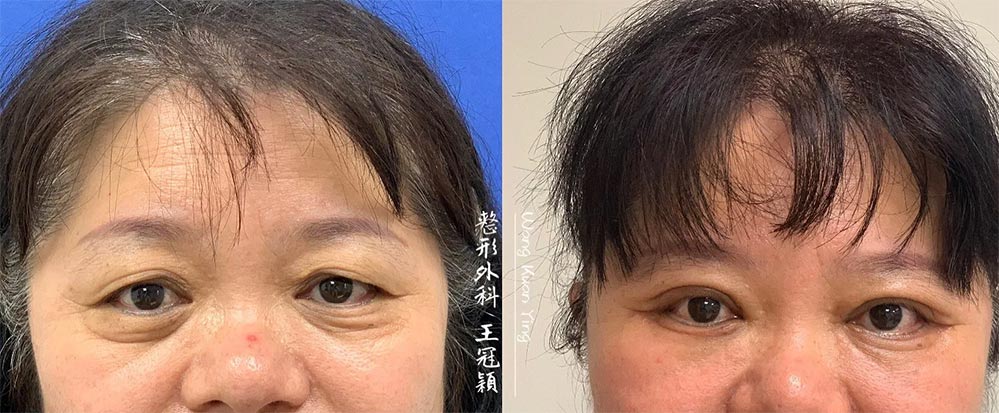 改善眼皮鬆弛與眼瞼下垂 拒絕嬸味｜自由時報