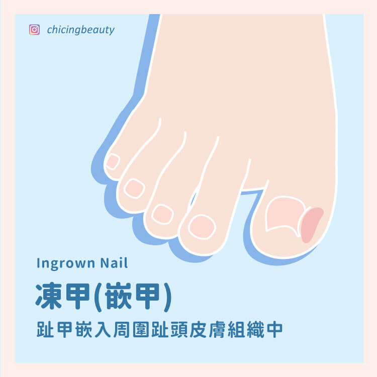 凍甲_陳建璋醫師_小黑醫師