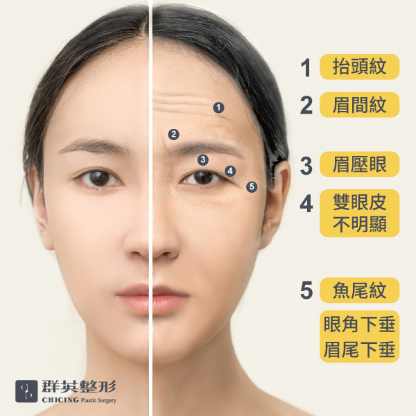 【內視鏡前額拉皮】40而已！我需要拉皮嗎？｜張世幸醫師