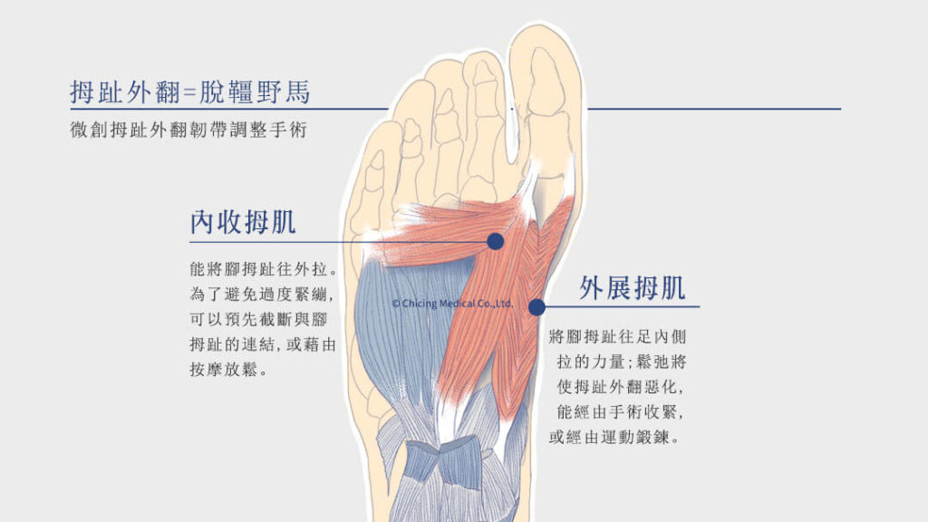 拇趾外翻可以預防？｜陳建璋醫師