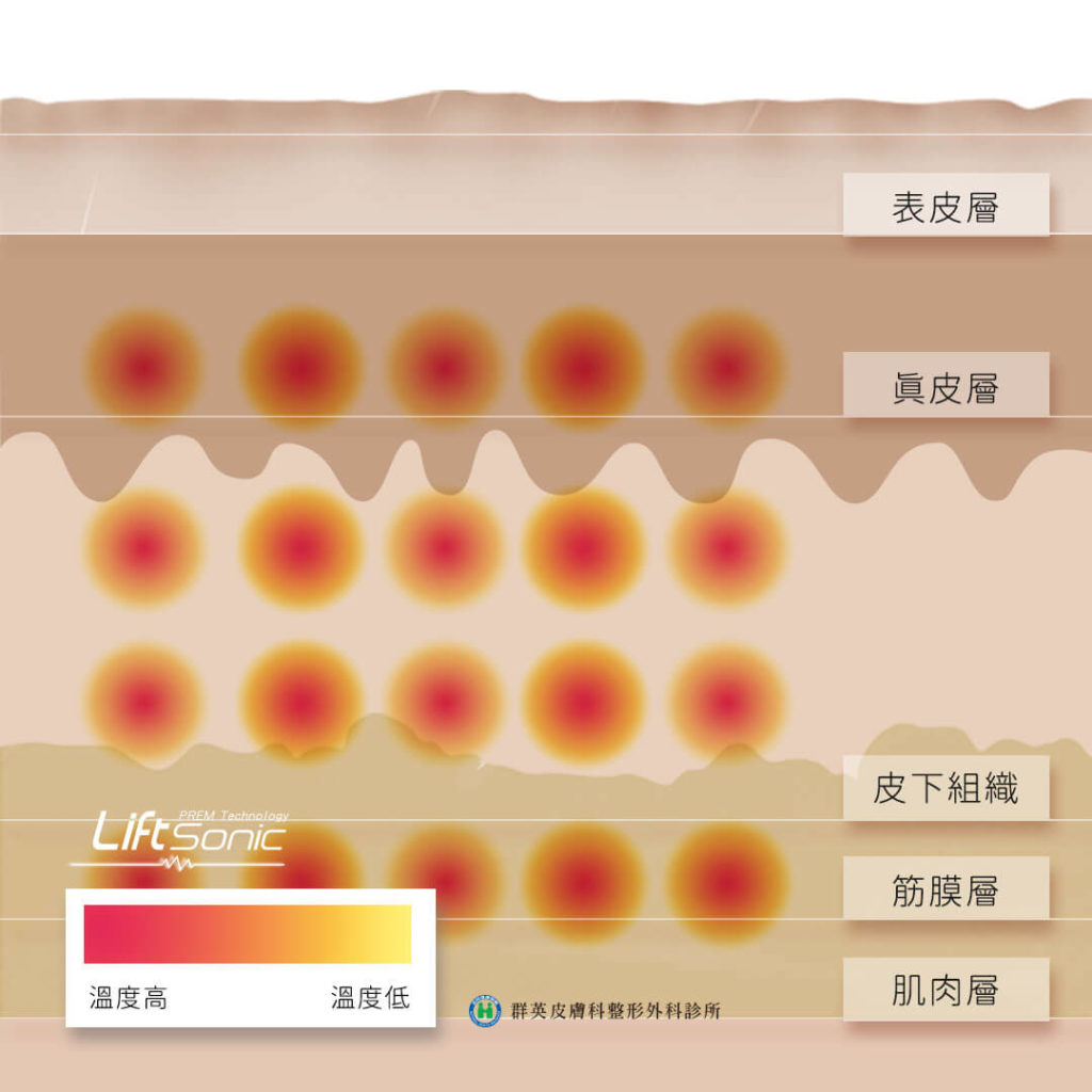 電波音波比較_音波改善皮膚鬆弛