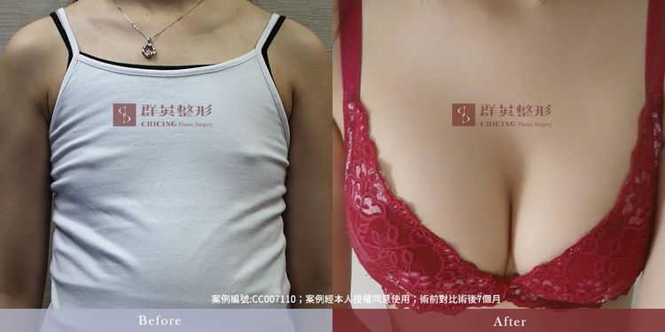 台中隆乳_隆乳手術_隆乳案例_推薦醫美診所_林雍球醫師