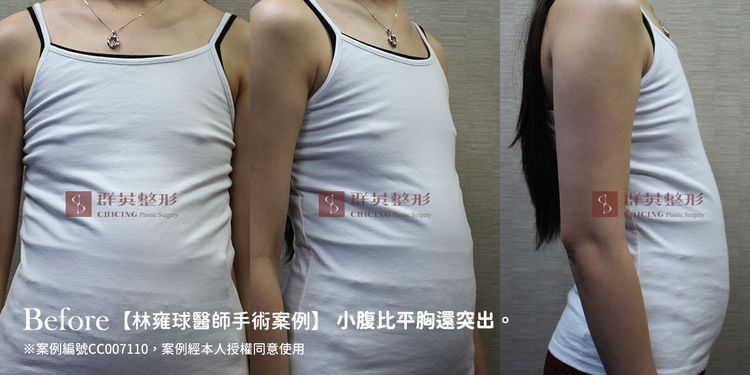 台中隆乳_隆乳手術_隆乳案例_推薦醫美診所_林雍球醫師