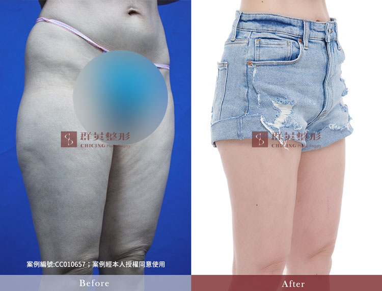 抽脂案例＿台中抽脂醫生推薦黃志宏＿台中威塑抽脂推薦＿馬鞍肉