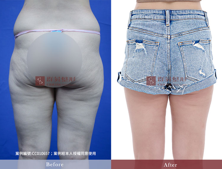 馬鞍肉抽脂＿台中威塑抽脂推薦＿馬鞍肉＿假胯寬＿黃志宏醫師