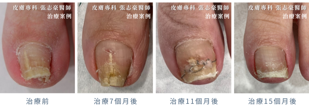 皮膚科張志豪醫師_灰指甲治療_趾甲矯正治療_案例1