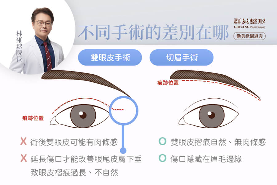雙眼皮手術與切眉手術的差別＿台中拉皮推薦台中群英林雍球醫師